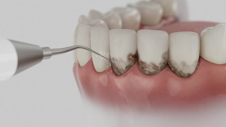 Reliable Wisdom Tooth Removal contractor in Union County County, MS by Dentist Open Now